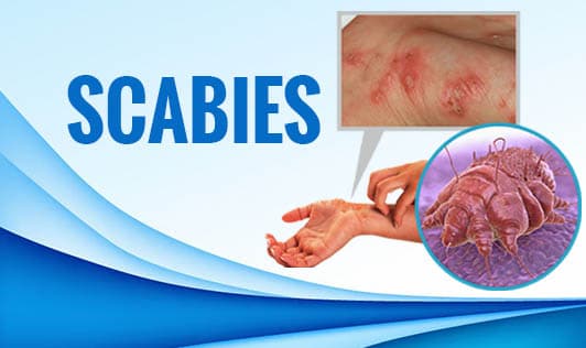 Scabies
