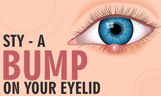 Sty - A Bump On Your Eyelid
