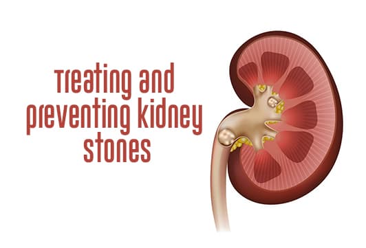 Treating and Preventing Kidney Stones