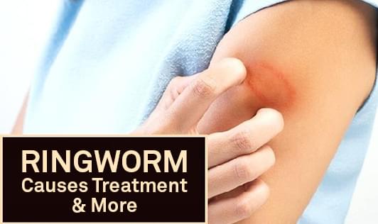 Ringworm: Causes, Treatment & More