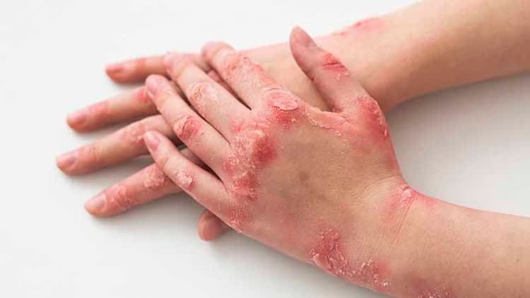 10 Strategies To Reduce Eczema (Itchy Red Skin)