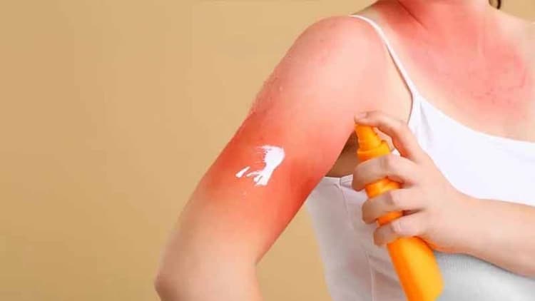 How To Detect And Manage Sun Allergies?