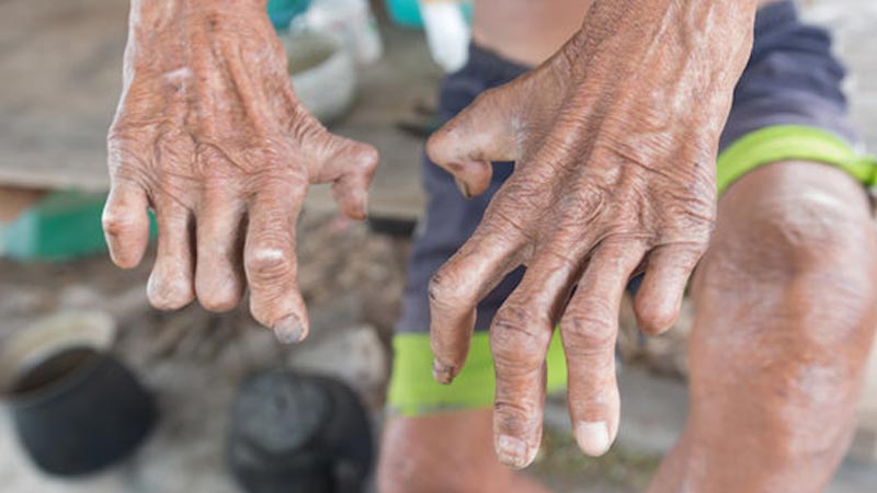 Leprosy (Hansen's disease): An Infection Caused By Slow-Growing Bacteria