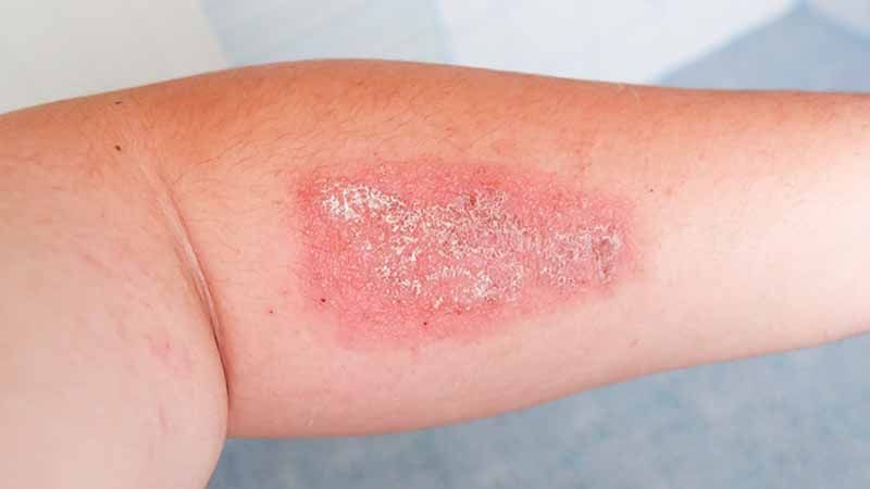 Staph Infections: Everything You Need To Know