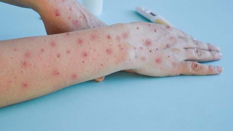 Understanding The Global Health Emergency Of The Mpox Virus