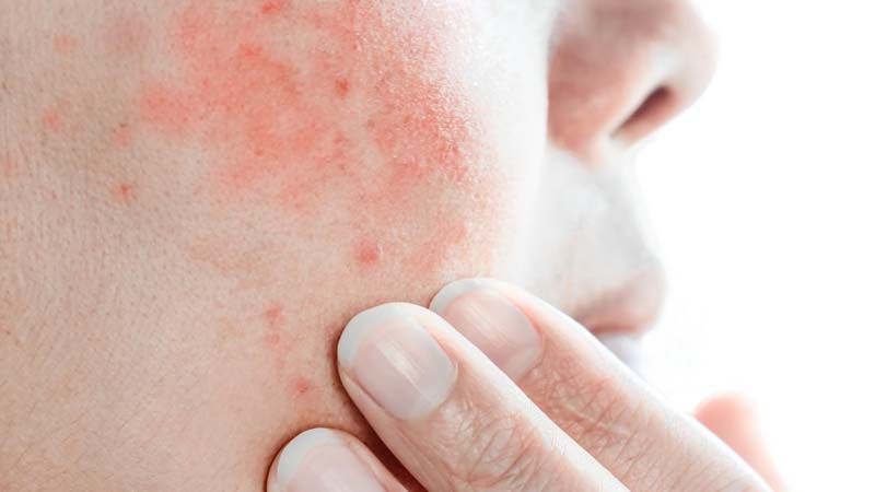 Winter Rash? Here’s What You Can Do