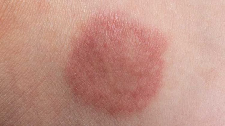 Jock Itch: Causes, Symptoms, Prevention, And Treatment